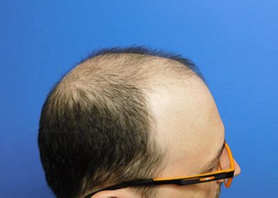 hair transplants st louis|Dr. Pawlinga .